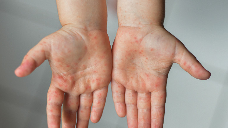 tipos de lupus para aposentadoria