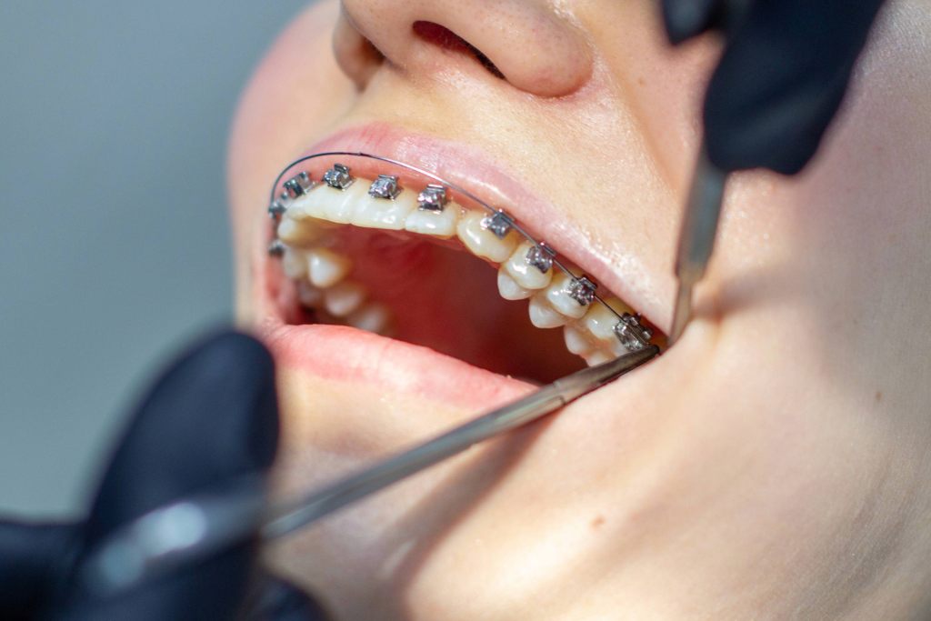 quem tem direito à cirurgia ortognática e o plano de saúde cobre